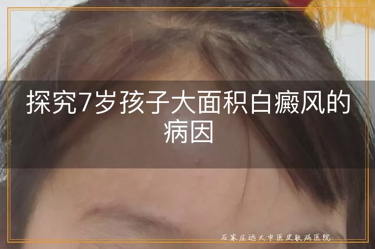 探究7岁孩子大面积白癜风的病因