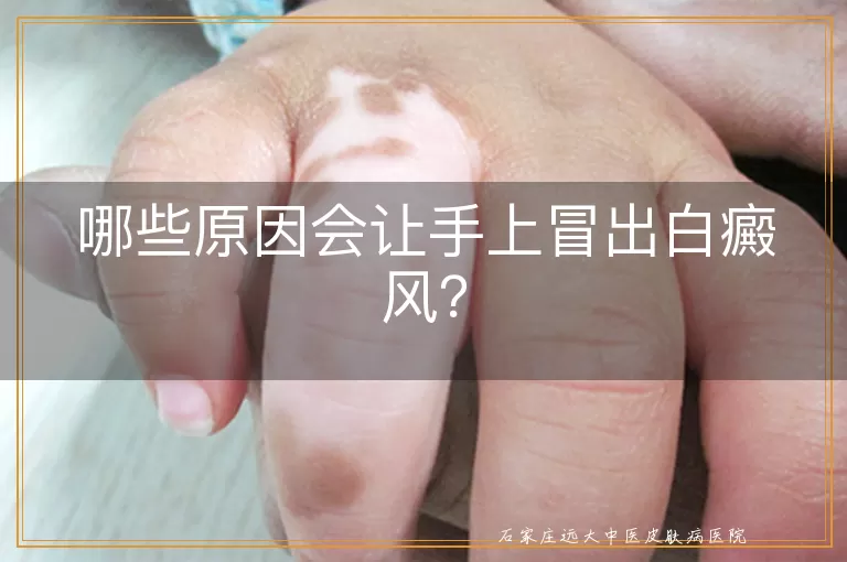 哪些原因会让手上冒出白癜风？