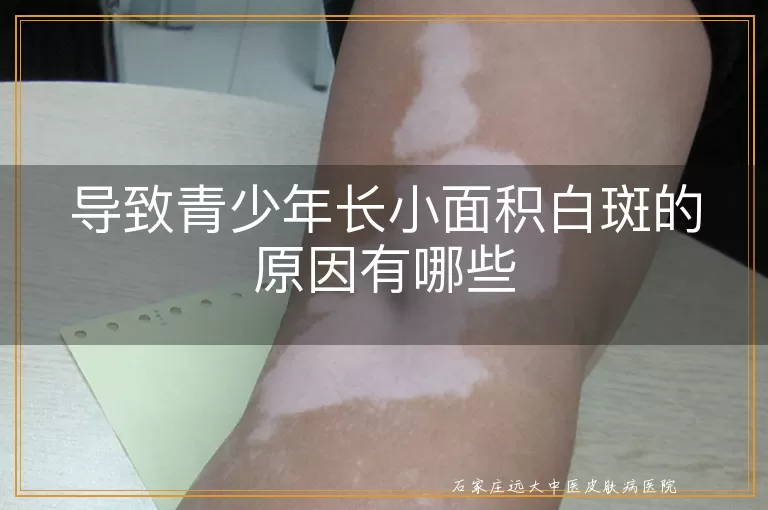 导致青少年长小面积白斑的原因有哪些