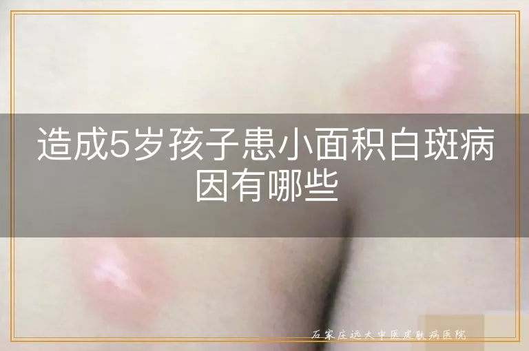 造成5岁孩子患小面积白斑病因有哪些