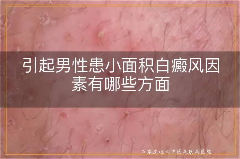 引起男性患小面积白癜风因素有哪些方面