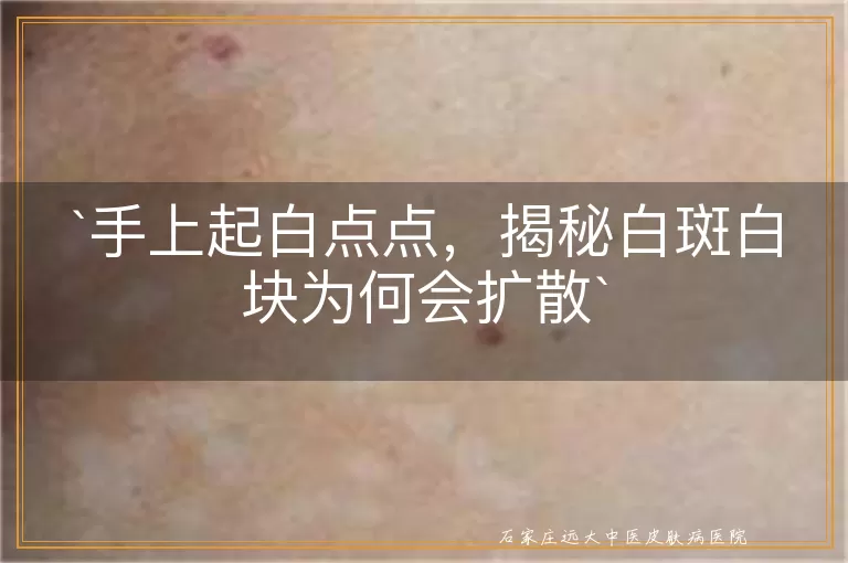 手上起白点点，揭秘白斑白块为何会扩散