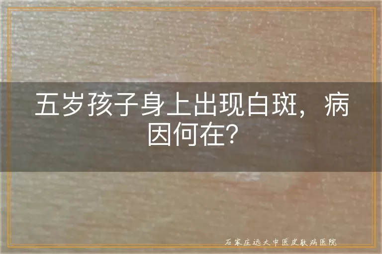 五岁孩子身上出现白斑,病因何在?