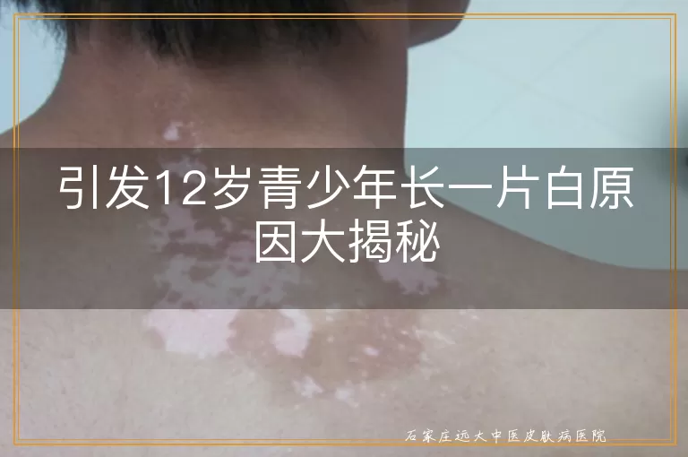 引发12岁青少年长一片白原因大揭秘