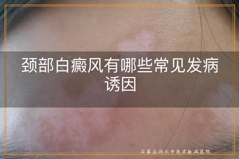 颈部白癜风有哪些常见发病诱因