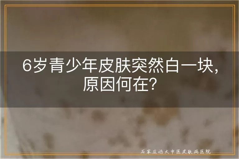 6岁青少年皮肤突然白一块，原因何在？