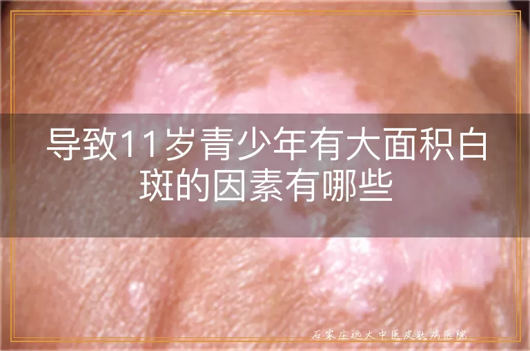 导致11岁青少年有大面积白斑的因素有哪些