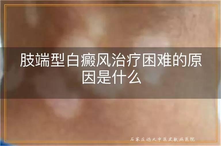 肢端型白癜风治疗困难的原因是什么