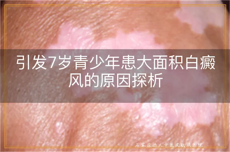 引发7岁青少年患大面积白癜风的原因探析