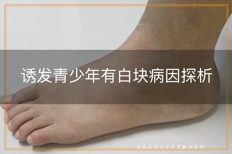 诱发青少年有白块病因探析
