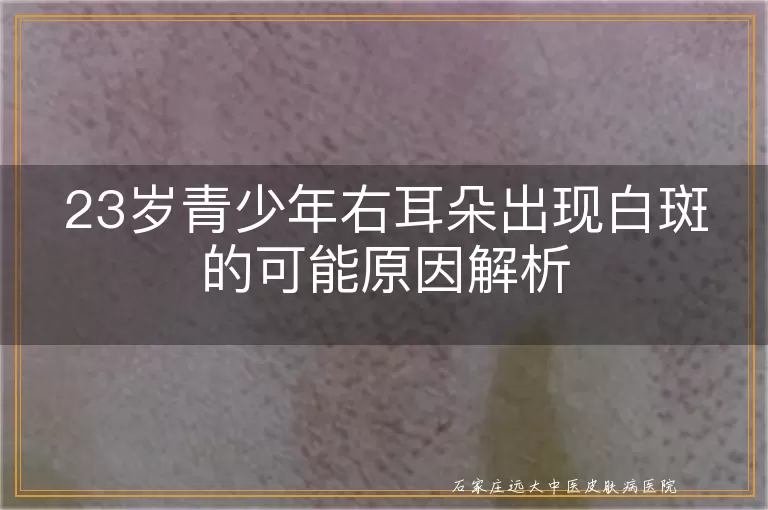 23岁青少年右耳朵出现白斑的可能原因解析