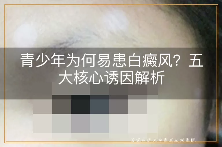 青少年为何易患白癜风？五大核心诱因解析