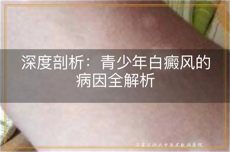 深度剖析：青少年白癜风的病因全解析