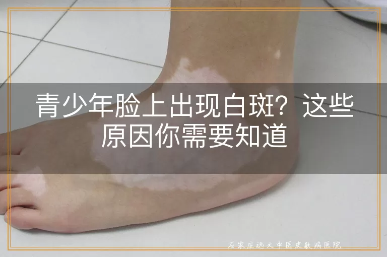 青少年脸上出现白斑？这些原因你需要知道