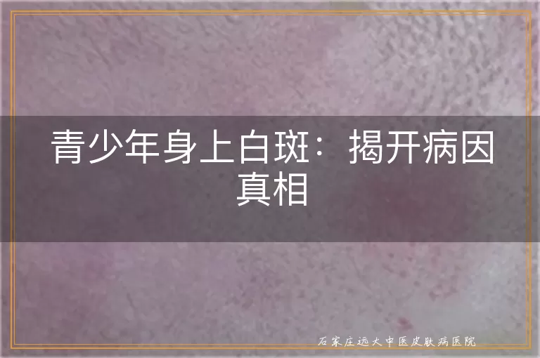 青少年身上白斑：揭开病因真相