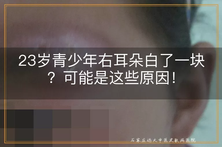 23岁青少年右耳朵白了一块？可能是这些原因！