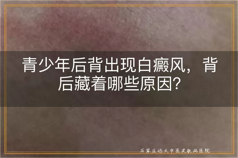 青少年后背出现白癜风，背后藏着哪些原因？