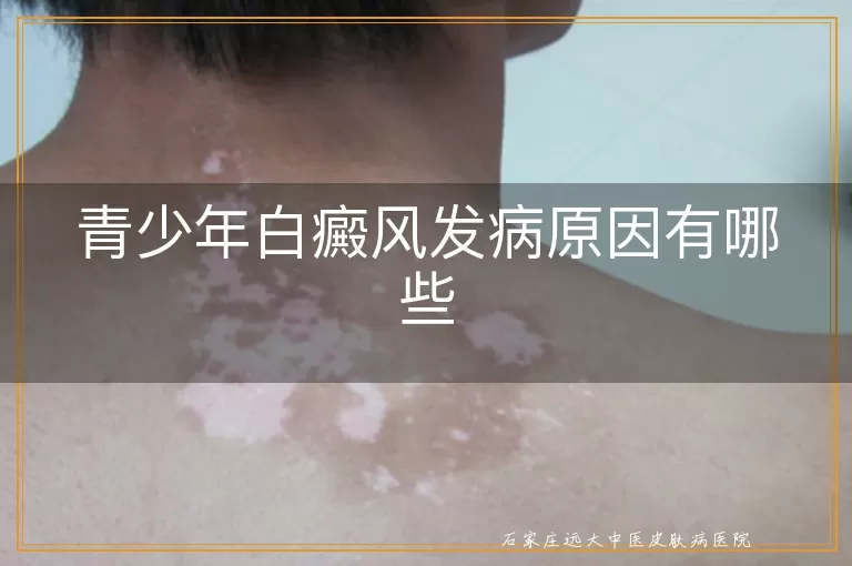 青少年白癜风发病原因有哪些