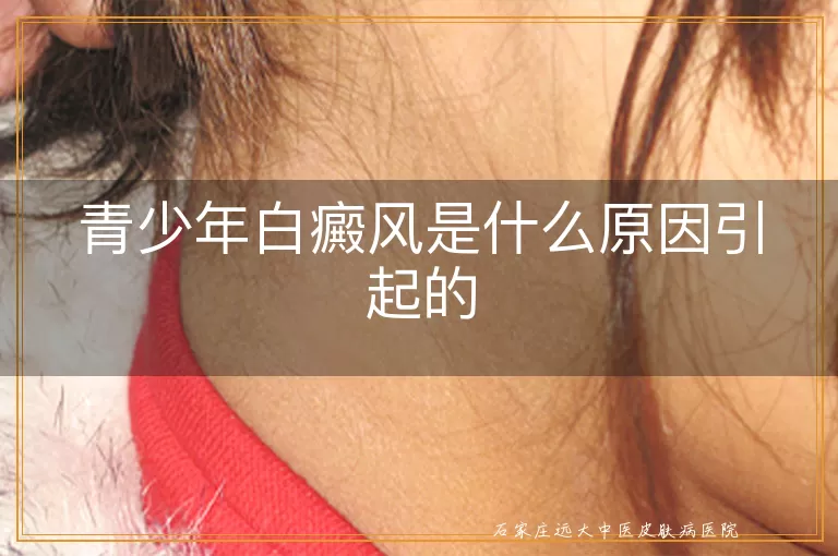 青少年白癜风是什么原因引起的