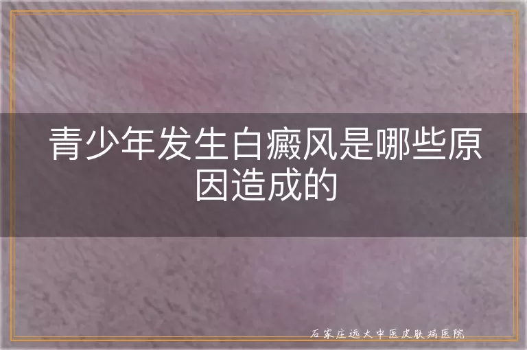 青少年发生白癜风是哪些原因造成的