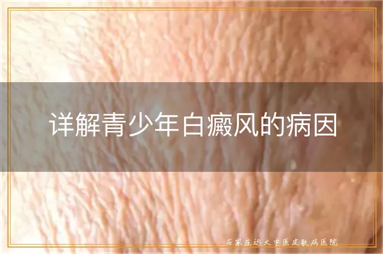 详解青少年白癜风的病因