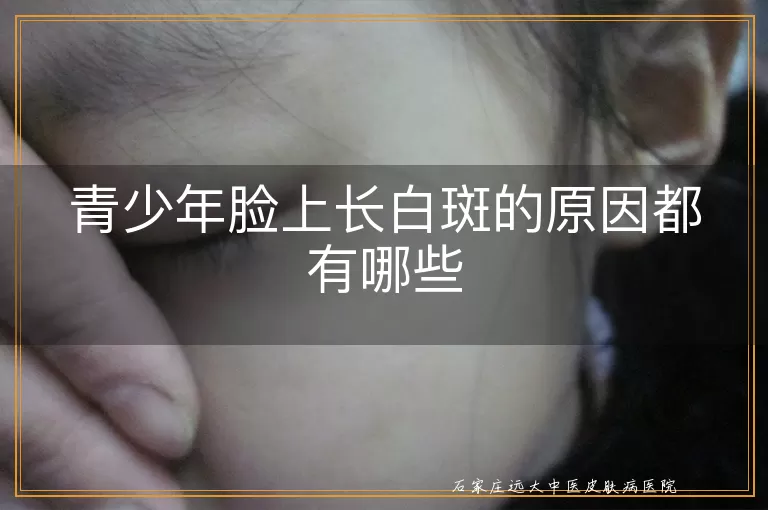 青少年脸上长白斑的原因都有哪些