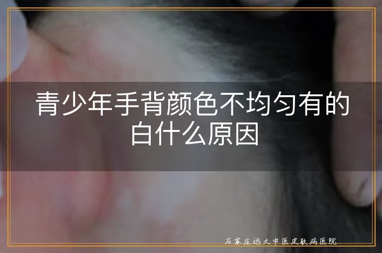 青少年手背颜色不均匀有的白什么原因