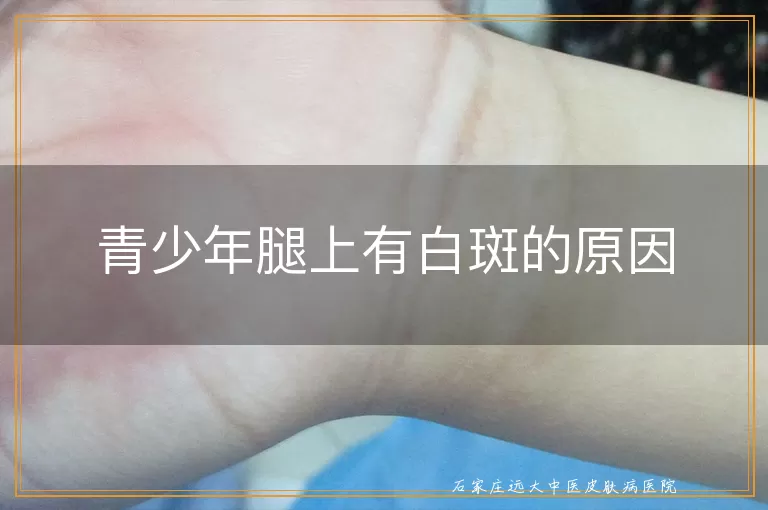 青少年腿上有白斑的原因