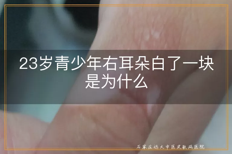 23岁青少年右耳朵白了一块是为什么