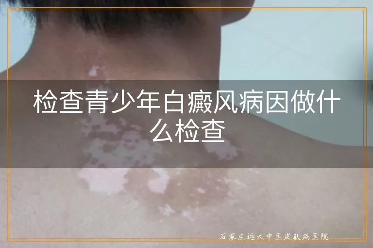 检查青少年白癜风病因做什么检查