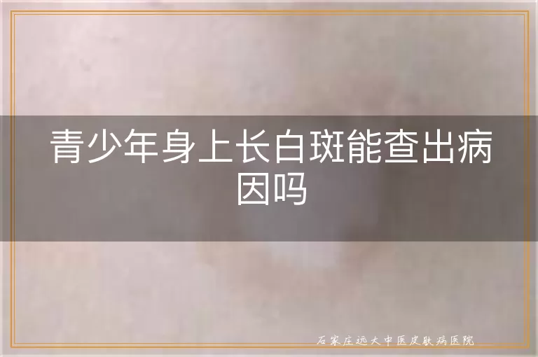 青少年身上长白斑能查出病因吗