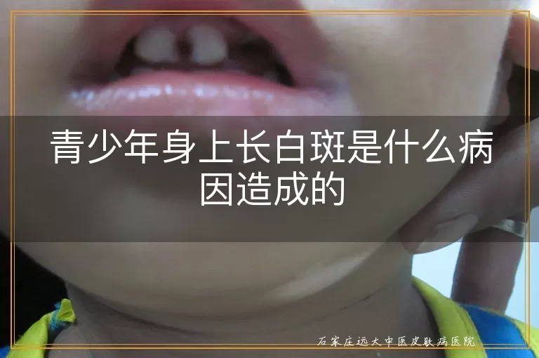 青少年身上长白斑是什么病因造成的