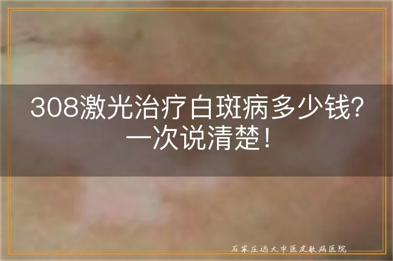 308激光治疗白斑病多少钱？一次说清楚！