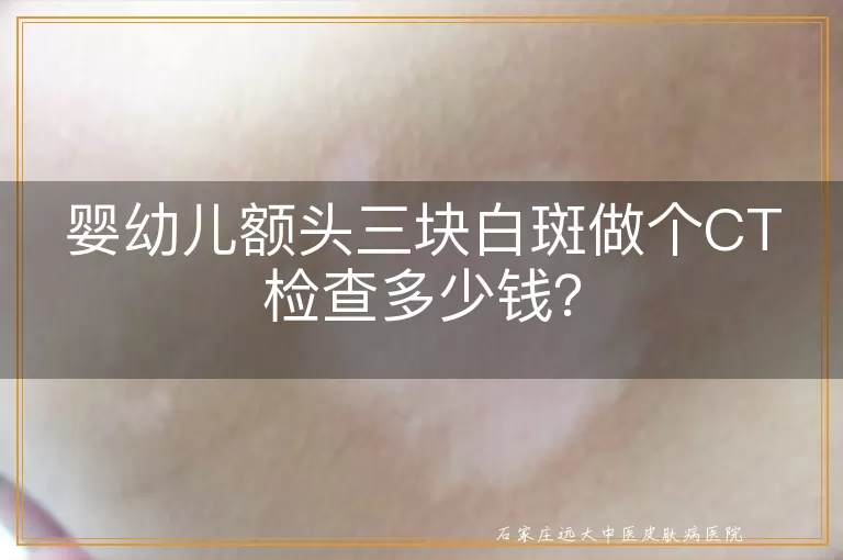 婴幼儿额头三块白斑做个CT检查多少钱？