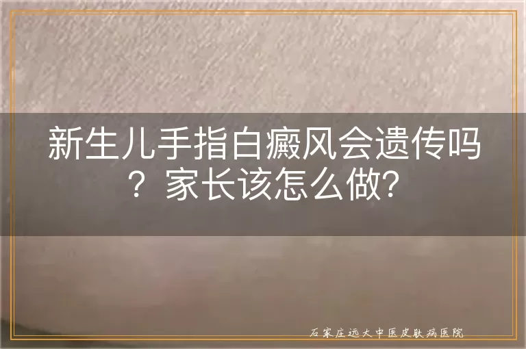 新生儿手指白癜风会遗传吗？家长该怎么做？