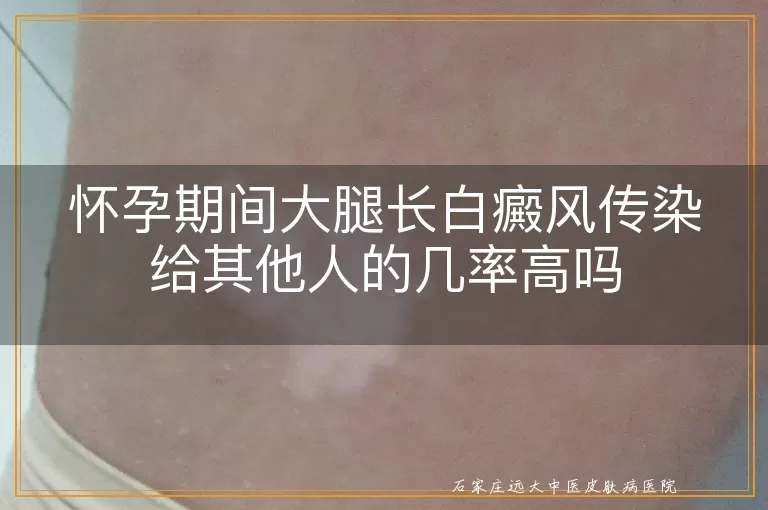 怀孕期间大腿长白癜风传染给其他人的几率高吗