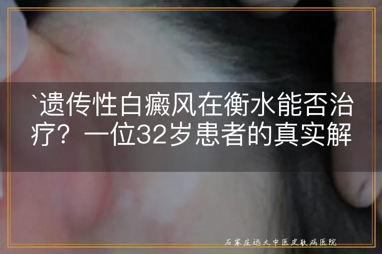 遗传性白癜风在衡水能否治疗？一位32岁患者的真实解答