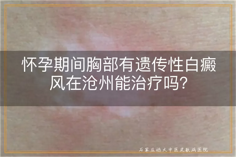 怀孕期间胸部有遗传性白癜风在沧州能治疗吗？