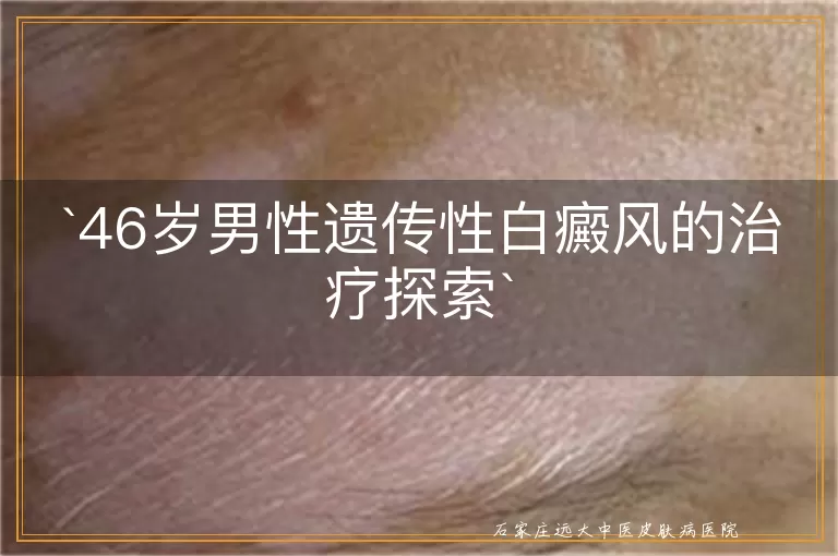 46岁男性遗传性白癜风的治疗探索