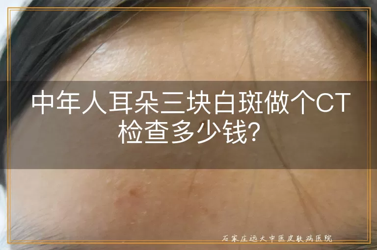 中年人耳朵三块白斑做个CT检查多少钱？