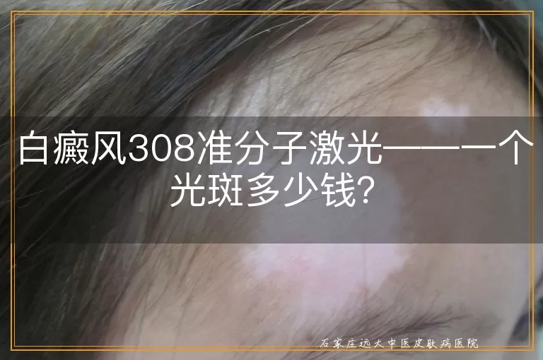 白癜风308准分子激光——一个光斑多少钱？