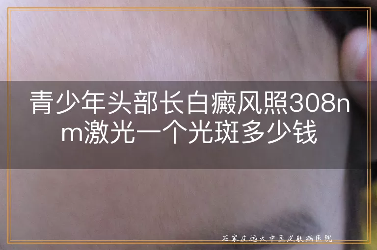 青少年头部长白癜风照308nm激光一个光斑多少钱