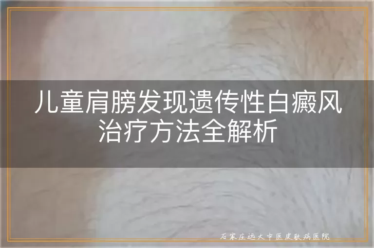 儿童肩膀发现遗传性白癜风治疗方法全解析