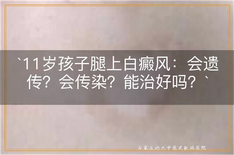 11岁孩子腿上白癜风：会遗传？会传染？能治好吗？