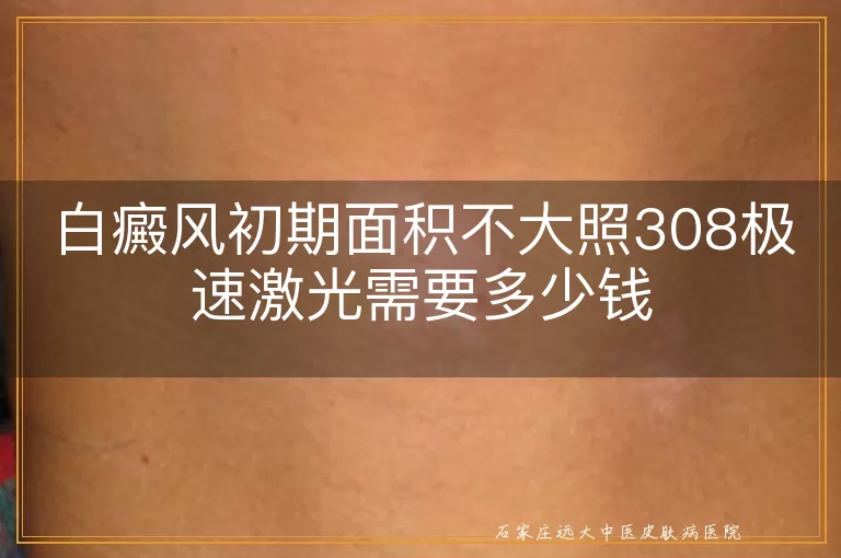 白癜风初期面积不大照308极速激光需要多少钱