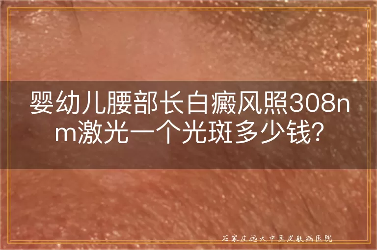 婴幼儿腰部长白癜风照308nm激光一个光斑多少钱？