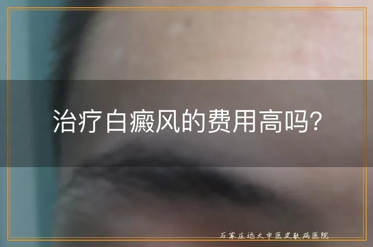 治疗白癜风的费用高吗？