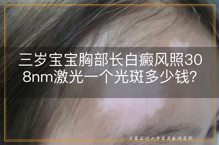 三岁宝宝胸部长白癜风照308nm激光一个光斑多少钱？