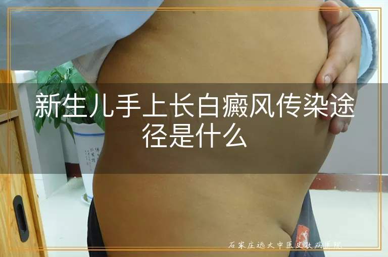 新生儿手上长白癜风传染途径是什么