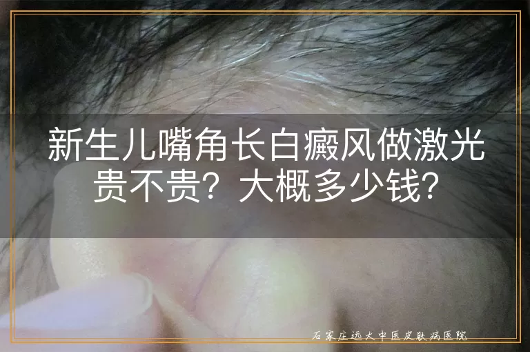 新生儿嘴角长白癜风做激光贵不贵？大概多少钱？